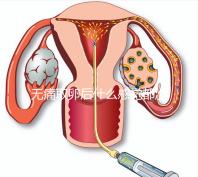 無痛取卵后什么感覺都沒有異常是謠言!只會出現一部分...