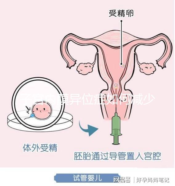 子宮內膜異位癥如何減少手術次數(shù),增加試管嬰兒成功率?