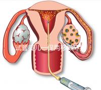 試管嬰兒一促兩移做環扎好看嗎?小心這些影響
