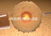 o型血孕婦患abo溶血癥幾率大，做好預防從備孕開始